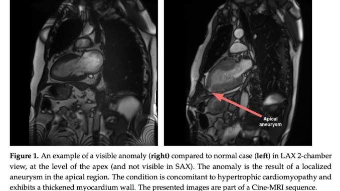 This AI Paper Explains the Effect of Data Augmentation on Deep-Learning-based Segmentation of Long-Axis Cine-MRI